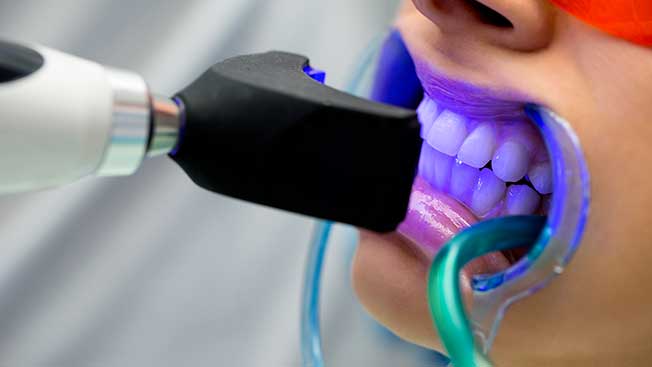 Clareamento com luz ultravioleta, uma nova tecnologia que aumenta o potencial de clareamento dos dentes. Este procedimento é realizado pela Dra. Mariana Coelho. Dentista especialista em Dentística Restauradora, que é a especialidade responsável pelos tratamentos estéticos.